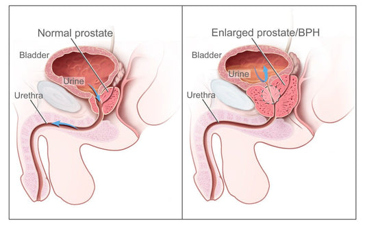 Prostate Medications vs Plant-Based Prostate Support Supplements: What to Consider - Nutrum Biotech